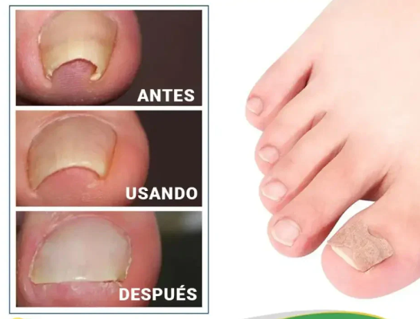Relief Oil | Tratamiento Anti-Hongos Natural para Uñas