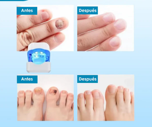 Tratamiento Láser para Hongos en las Uñas