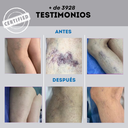 VARICOSE VEINS | ADIÓS VENAS SPRAY
