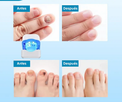 Tratamiento Láser para Hongos en las Uñas